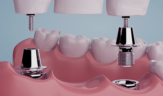 글 쓰는 전문가들 : ﻿﻿임플란트 치과마다 차이 나는 이유는? | 임플란트, 혹시 이것도 아셨나요?